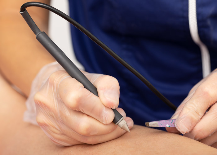 close up of electrolysis treatment