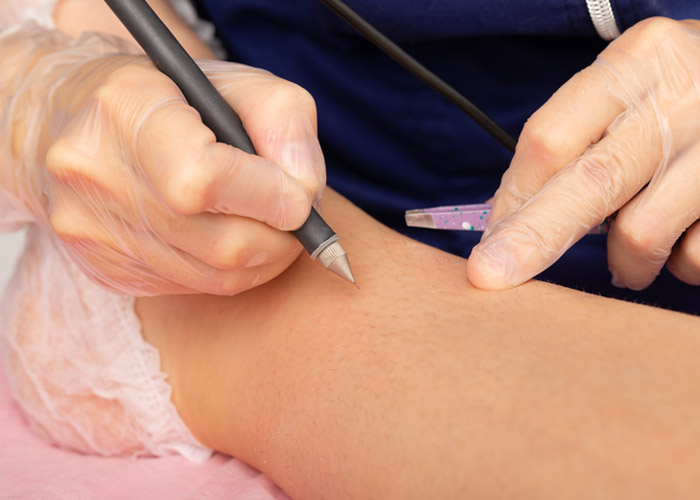 close up of electrolysis treatment